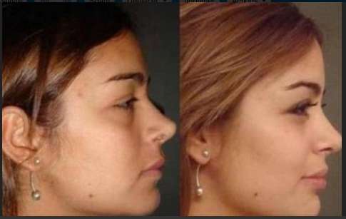 Larissa Riquelme est refaite