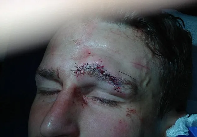 Photo: La tête amochée de Huth