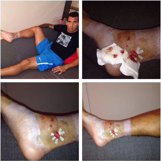 Photo: La cheville de Tévez