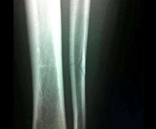 Photo : Bergessio partage sa fracture