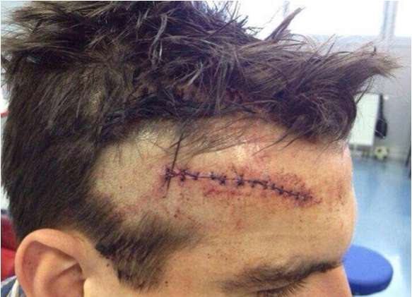 Photo : Une vilaine cicatrice