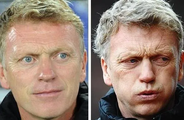 Coachs : la chirurgie au service du coup de vieux