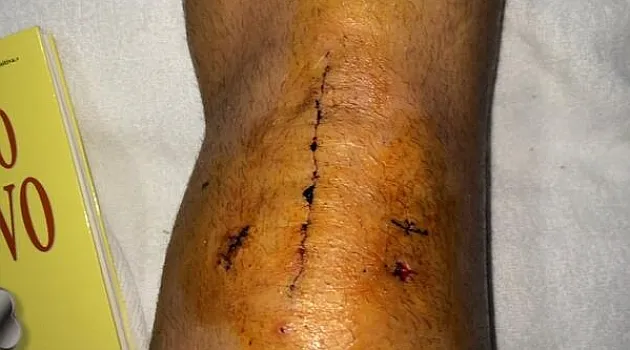 Photo : Le genou de Jesé