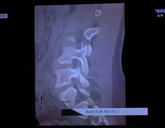 Photo : Neymar à 2cm de la paralysie ?