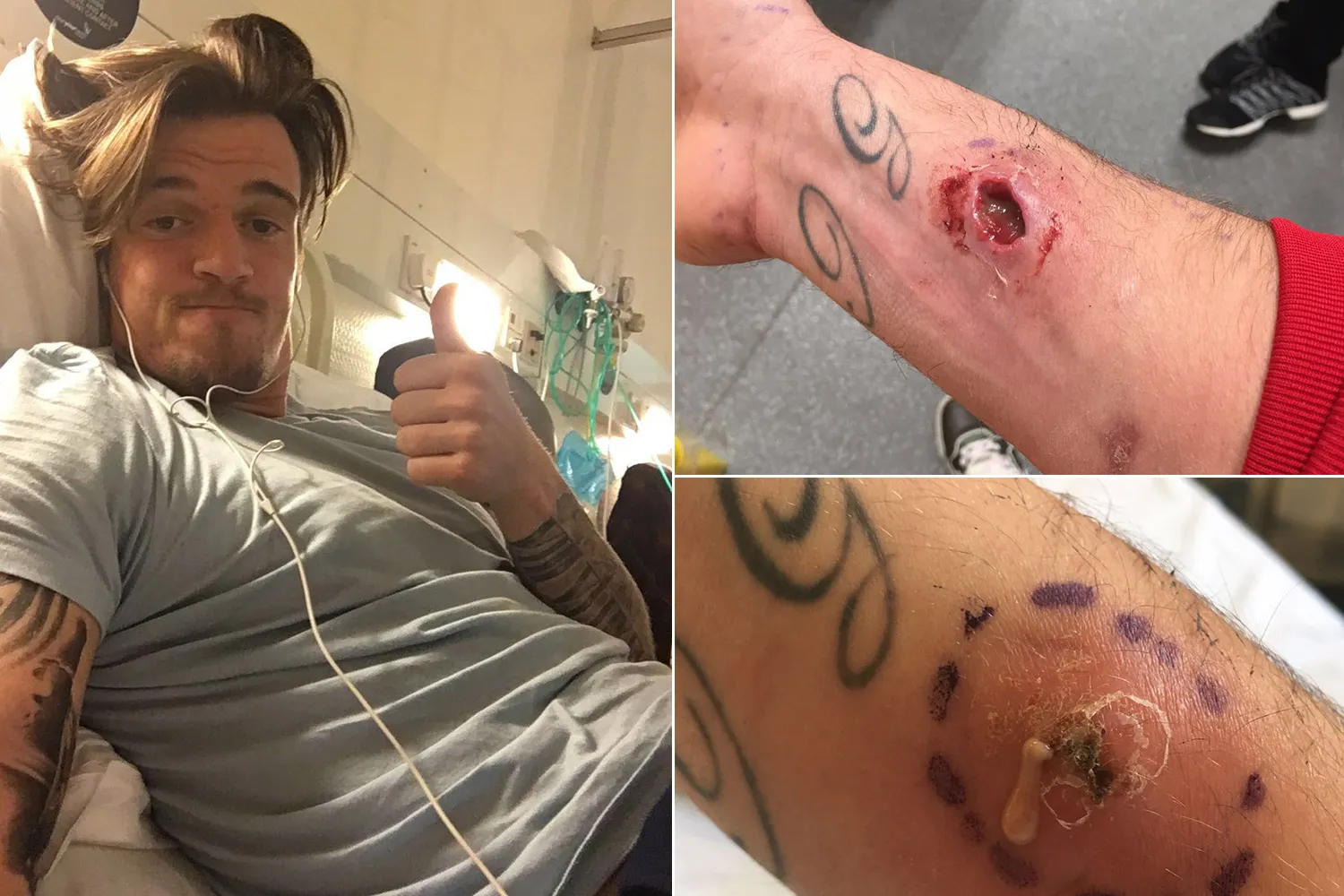 Un mois d’arrêt à cause d’une morsure d’araignée