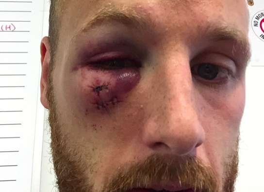 Photo : L&rsquo;œil fracassé d&rsquo;un joueur de Hull City