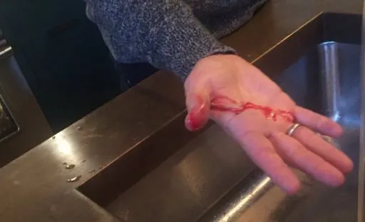 Photo : Lineker se blesse à la main pour Noël