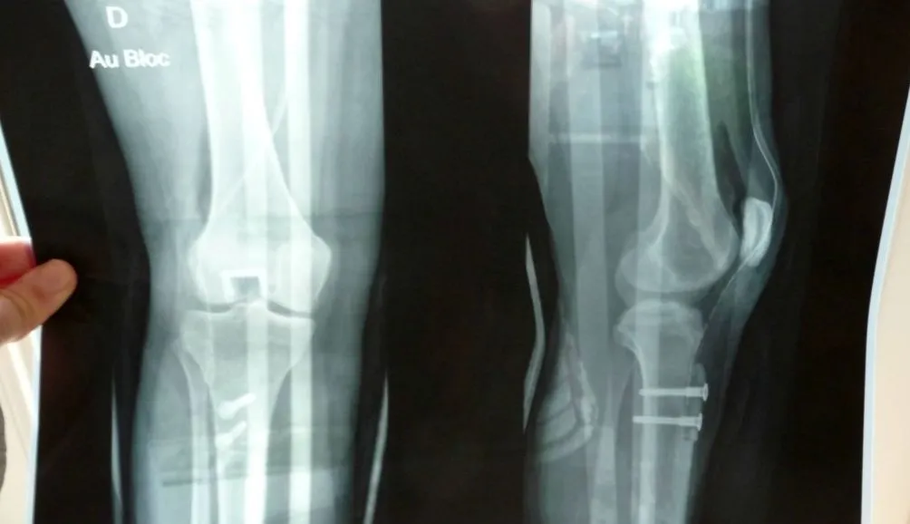 Top 5 : Football et radiologie