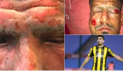 Lucas Viatri brûlé au visage à cause d&rsquo;un feu d&rsquo;artifice